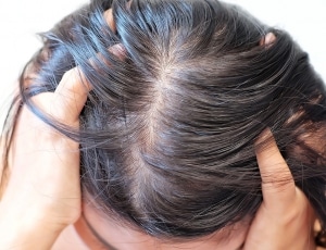 Oily and itchy scalp